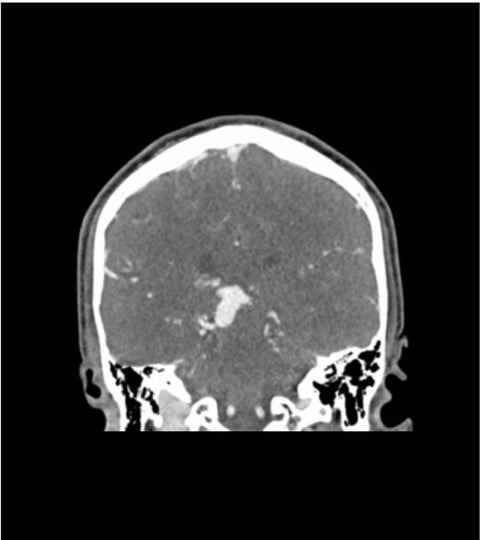 Fantomă cap “MAV și leziuni” pentru CT, radiografie și radioterapie