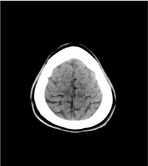 Fantomă pentru cap – accident vascular cerebral / hemoragie