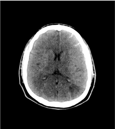 Fantomă pentru cap – accident vascular cerebral / hemoragie