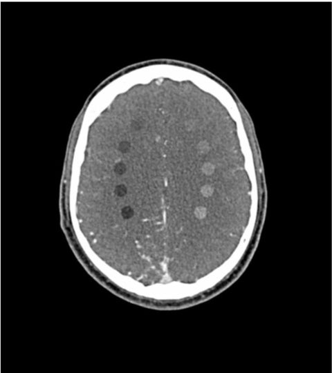 Fantomă pentru cap și gât „AVM și leziune” pentru CT, radiografie și radioterapie