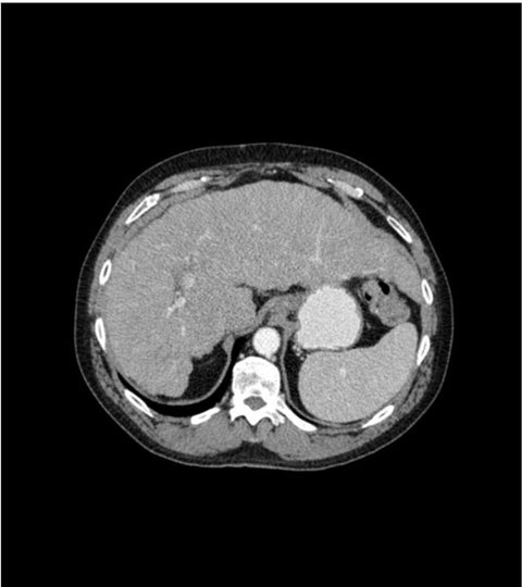 Fantomă abdominală fază portală cu ciroză