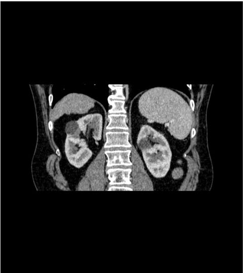 Fantomă abdominală fază portală cu ciroză