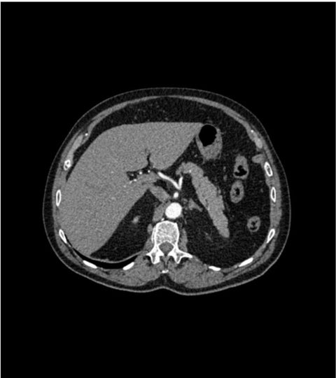 Fantomă abdominală cu anevrism aortic