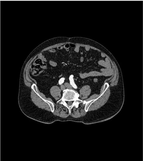 Fantomă abdominală cu anevrism aortic