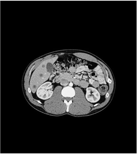 Fantomă abdomen pv cilindri micști