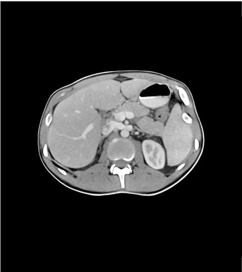 Fantomă abdomen/pelvis, faza venoasă portală