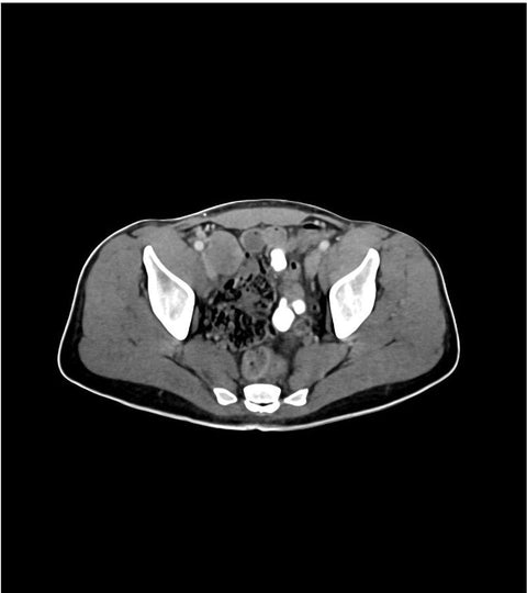 Fantomă abdomen/pelvis, faza venoasă portală