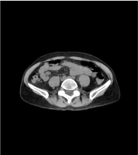 Fantomă abdomen / pelvis nativă