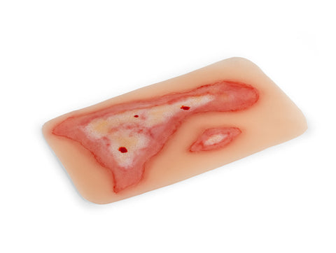 Moulage rană opărire