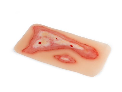 Moulage rană opărire