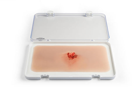 Moulage fractură deschisă, os braț cu funcție de sângerare