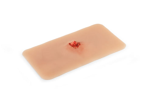 Moulage fractură deschisă, os braț cu funcție de sângerare