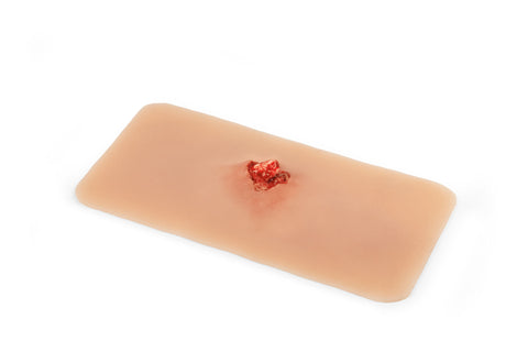 Moulage fractură deschisă, os braț cu funcție de sângerare