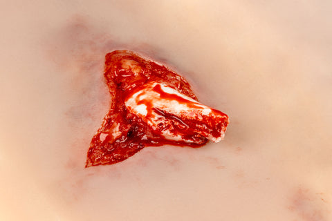 Moulage fractură deschisă, picior cu funcție de sângerare