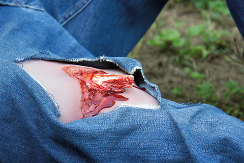 Moulage fractura deschisă, picior cu funcție de sângerare