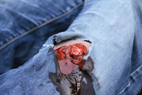 Moulage fractura deschisă, picior cu funcție de sângerare