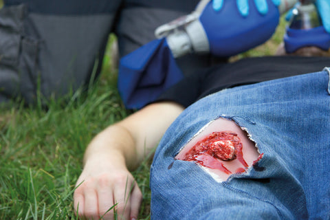Moulage fractura deschisă, picior cu funcție de sângerare