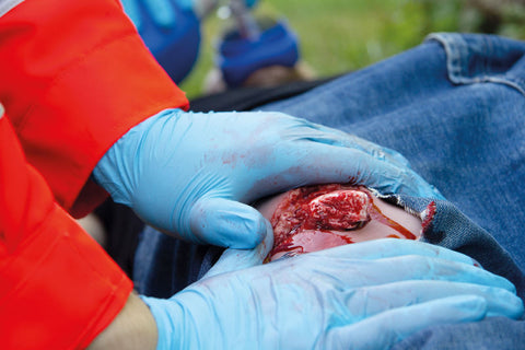 Moulage fractura deschisă, picior cu funcție de sângerare