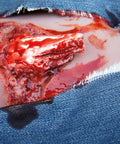 Moulage fractura deschisă, picior cu funcție de sângerare