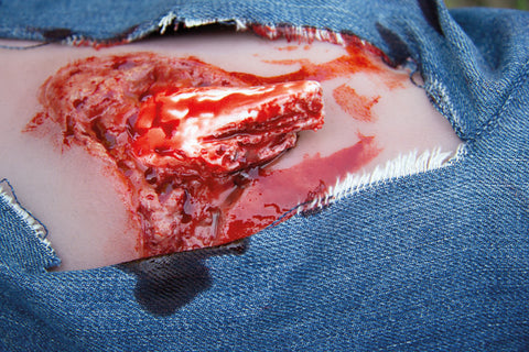 Moulage fractura deschisă, picior cu funcție de sângerare