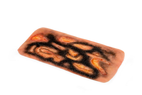 Moulage arsură de gradul 3