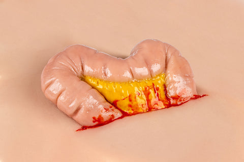 Moulage protruziune intestin gros
