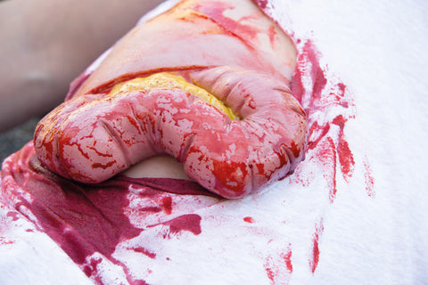 Moulage protruziune intestin gros