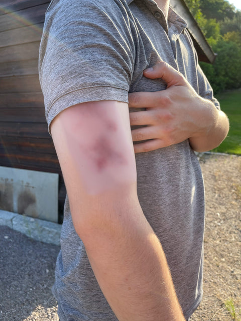 Wound moulage hematoma fresh