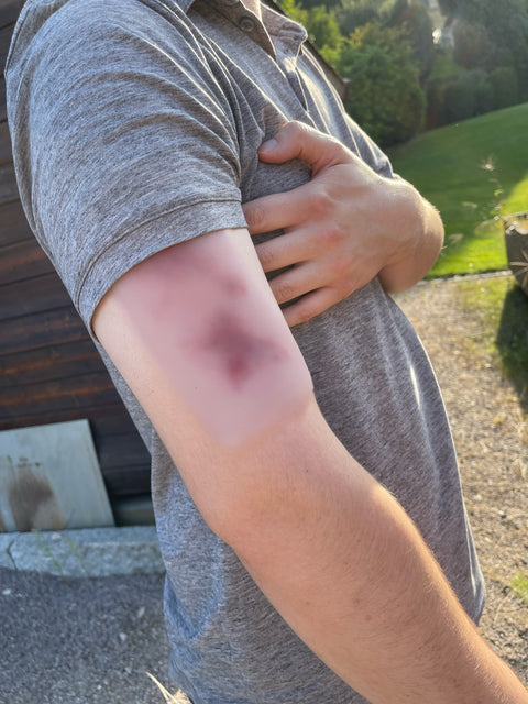 Wound moulage hematoma fresh