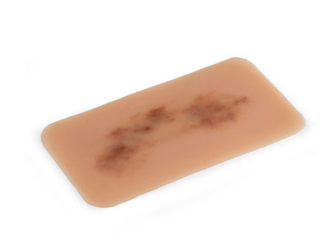 Moulage hematom proaspăt