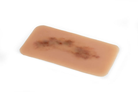Moulage hematom proaspăt