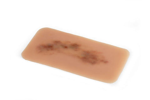 Moulage hematom proaspăt