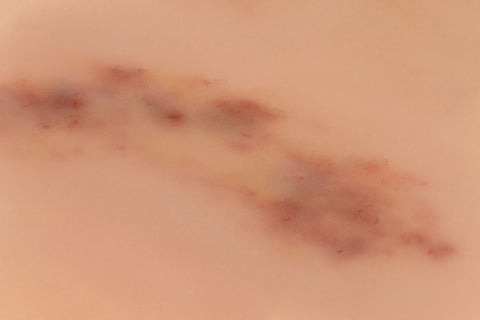 Moulage hematom proaspăt