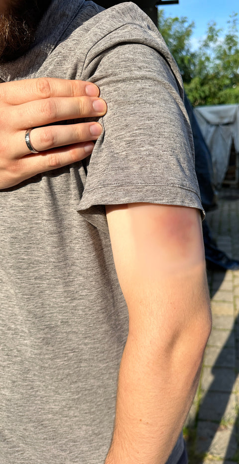 Wound moulage Hematoma older