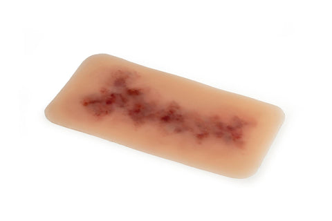Moulage hematom mai vechi