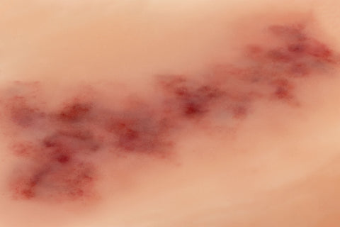 Moulage hematom mai vechi