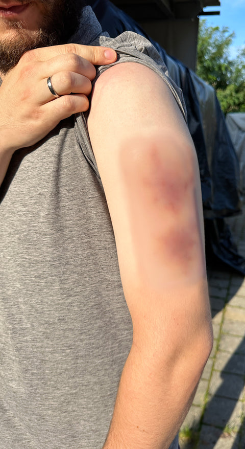 Moulage hematom mai vechi
