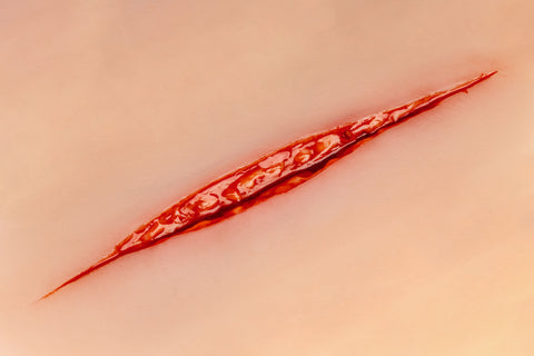 Moulage încercare de sinucidere