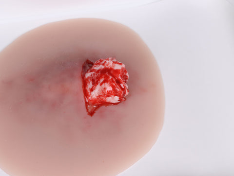 Wound presentation open fracture ankle joint