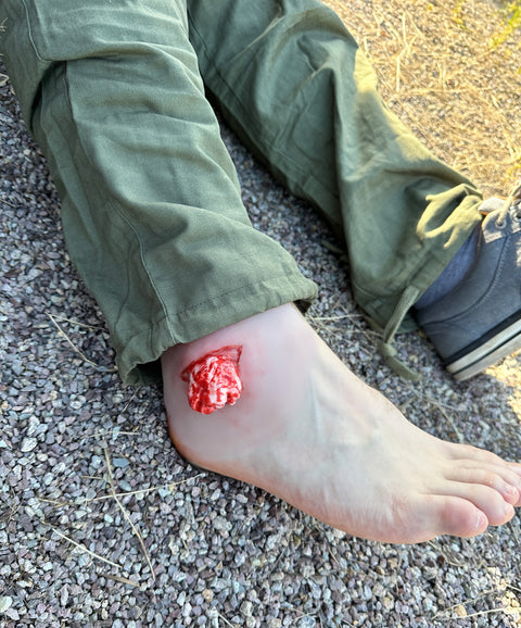 Wound presentation open fracture ankle joint