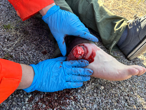 Wound presentation open fracture ankle joint