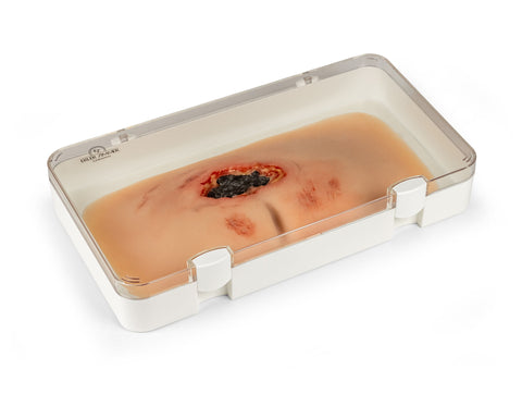 Moulage rană decubit sacral, netratată