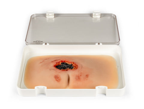 Moulage rană decubit sacral, netratată