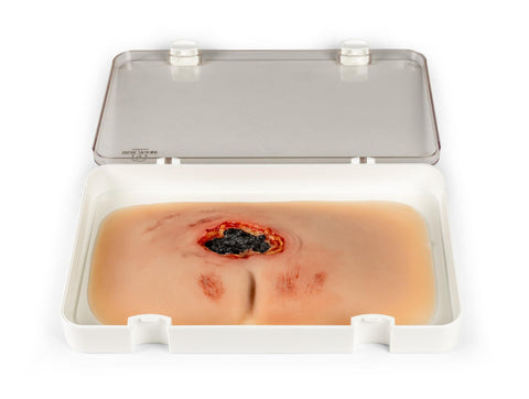 Moulage rană decubit sacral, netratată