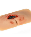 Moulage rană decubit sacral, netratată