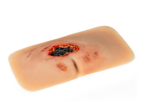 Moulage rană decubit sacral, netratată