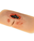 Moulage rană decubit sacral, netratată