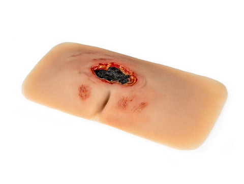 Moulage rană decubit sacral, netratată