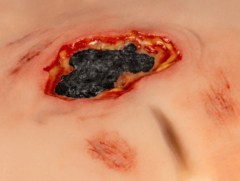 Moulage rană decubit sacral, netratată