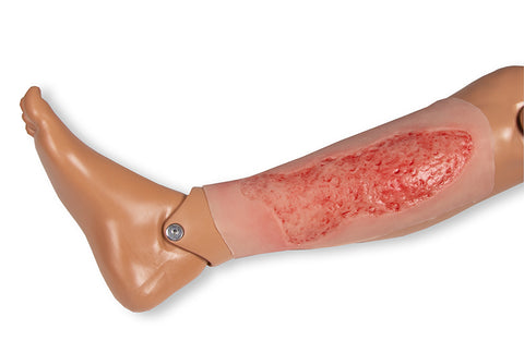 Wound moulage venous leg ulcer, large, epithelisation phase